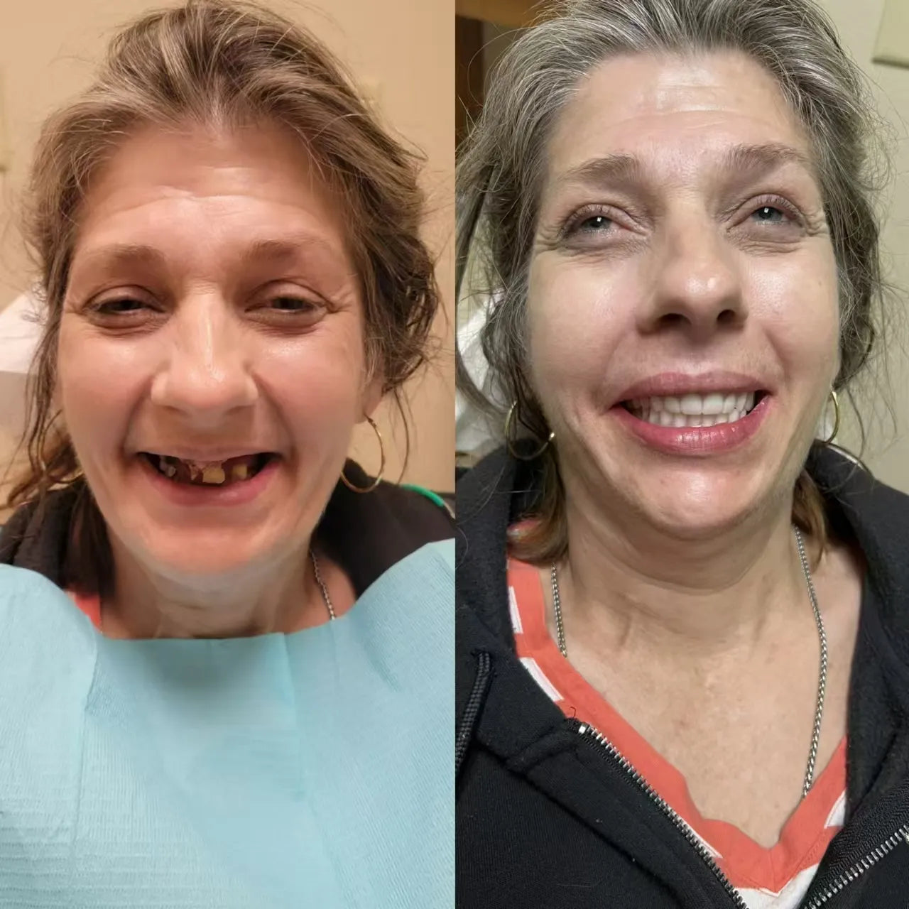 Easy Denture™ proteză universală reglabilă din silicon compozit ceramic
