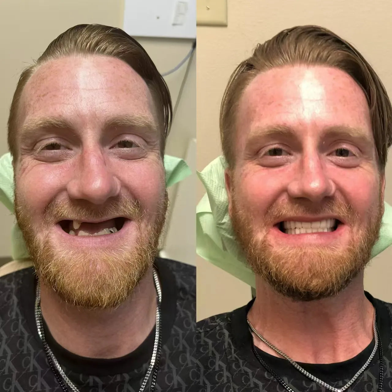 Easy Denture™ proteză universală reglabilă din silicon compozit ceramic
