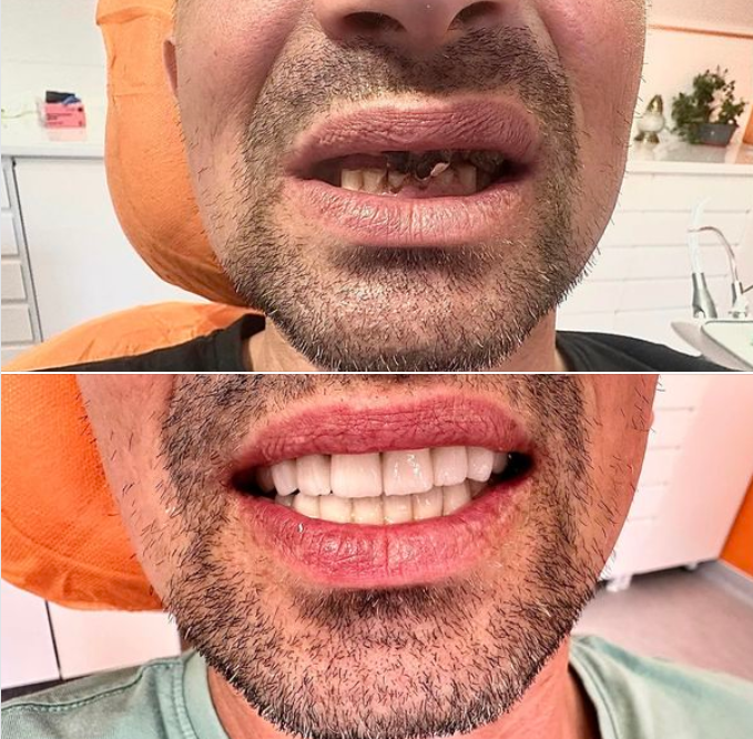 Proteze dentare compozite ceramice din silicon universal Fivfivgo™